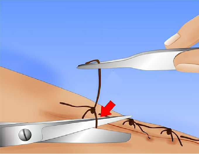 Suture Removal